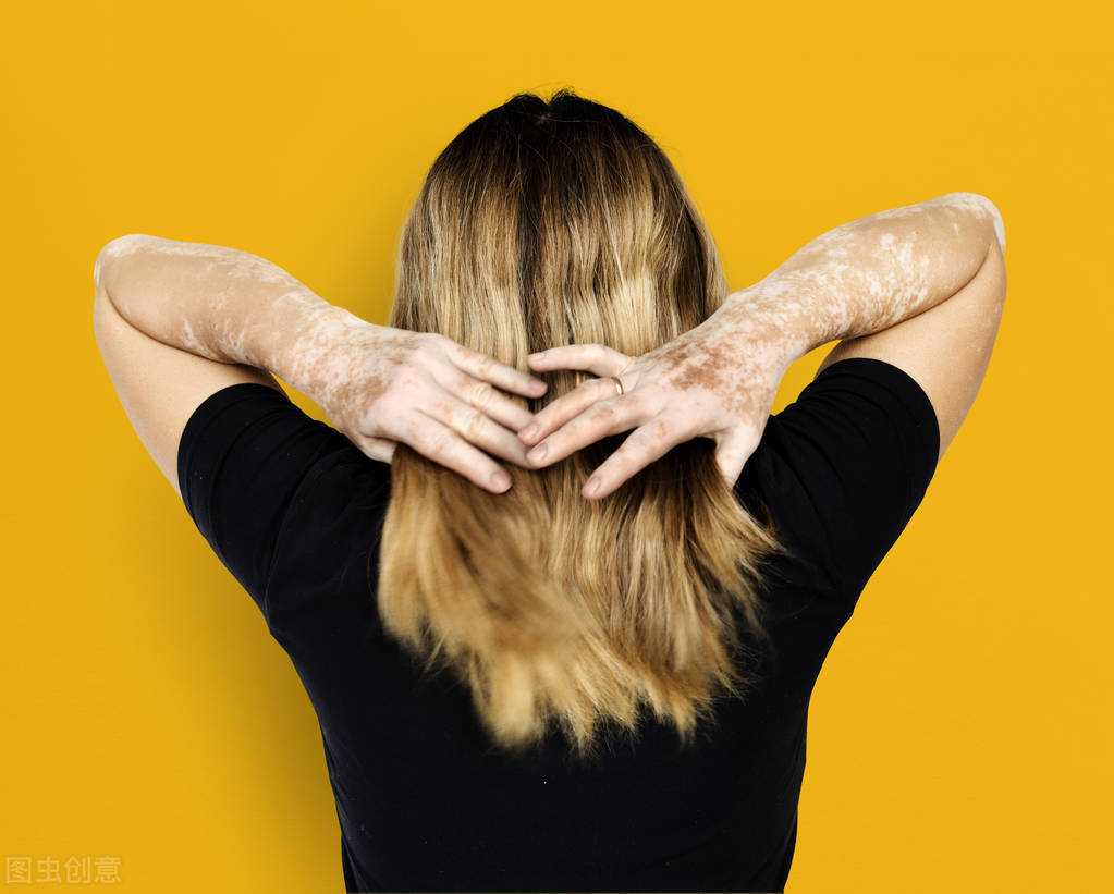 外用药物能治好白癜风么？