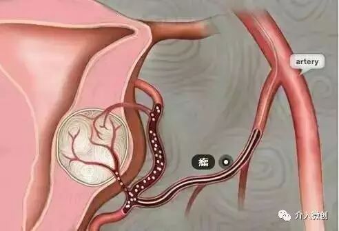 宫外孕保守治疗显示子宫腺肌症,子宫腺肌病保守治疗无效怎么办