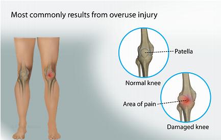 疼痛是什么？我们从事肌骨疼痛方向的物理治疗师究竟在干什么？