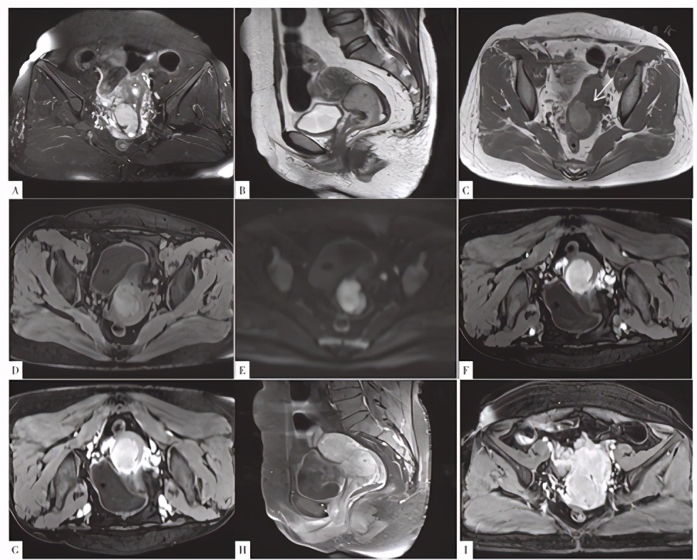 子宫良恶性肿瘤的超声诊断及鉴别,子宫肌瘤病理切片恶性肿瘤