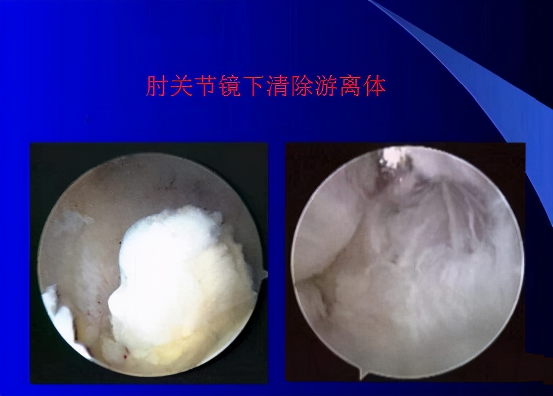 创伤导致肘关节僵硬怎样才能康复,肘关节僵硬松解手术康复训练