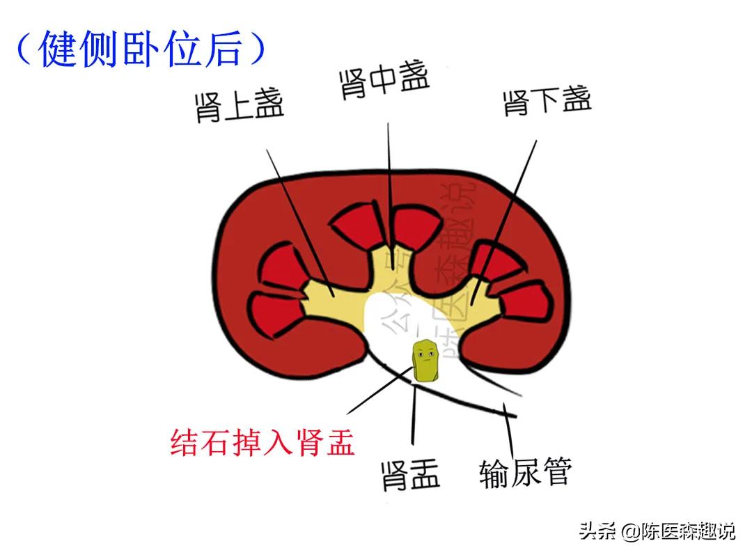 肾下盏结石怎么能排出来,左肾结石6mm多久能自然排出