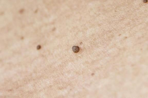 扁平疣不去抓它会继续扩大范围吗,扁平疣抓掉了用什么药好