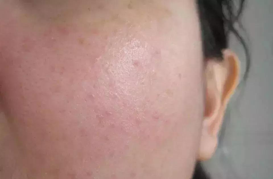 皮肤化妆品过敏最快缓解方法,皮肤过敏一定是化妆品的错吗