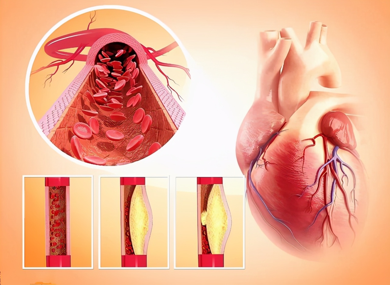 有冠心病经常害怕受惊吓怎么办,得了冠心病每天提心吊胆怎么办