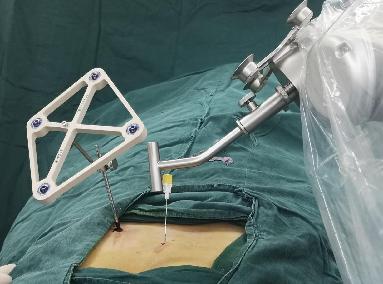 西安市红会医院成功完成机器人辅助下骶神经调节术