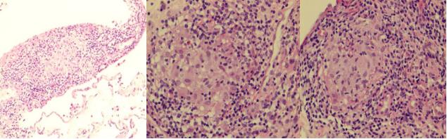 肺部陈旧病灶会变大么,肺部病灶1.2厘米严重吗
