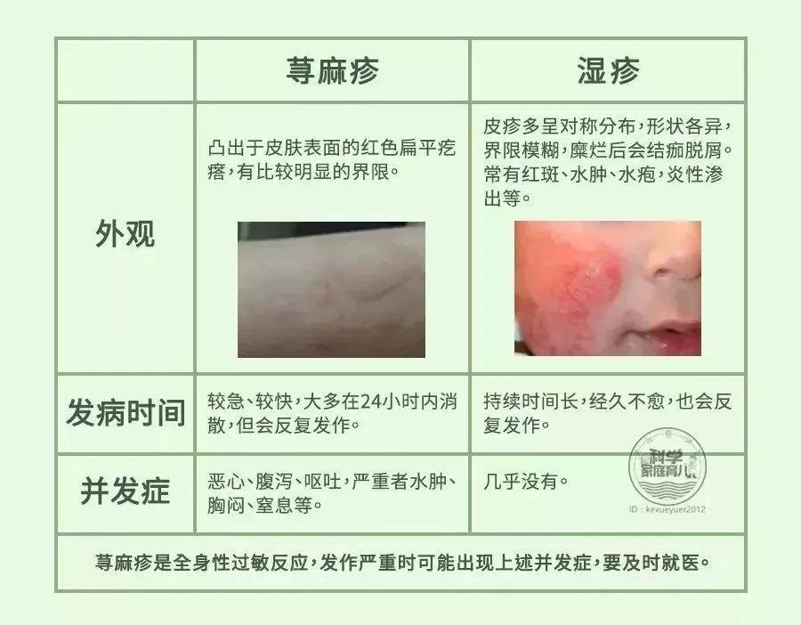 娃身上出了荨麻疹怎么办,娃儿有皮疹怎么止痒