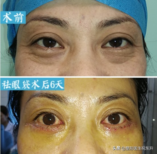 眼袋越来越重是身体哪里出问题了,为什么你会有眼袋