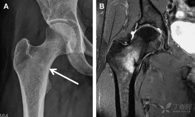 值夜班急救措施,放射科容易漏诊的骨折