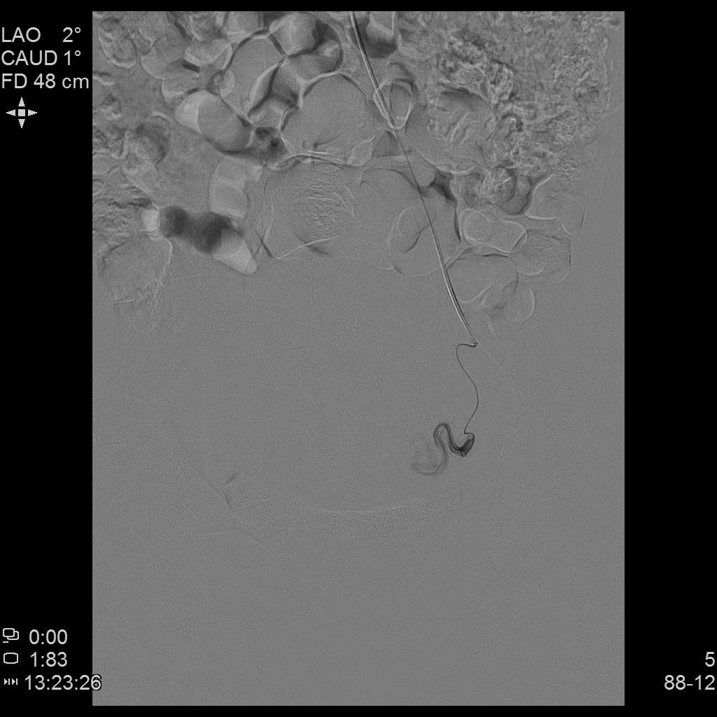 子宫腺肌症称为不死的癌症,子宫腺肌症是不死的癌症吗