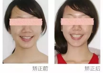 正畸主治学习视频,正畸钟摆效应名词解释