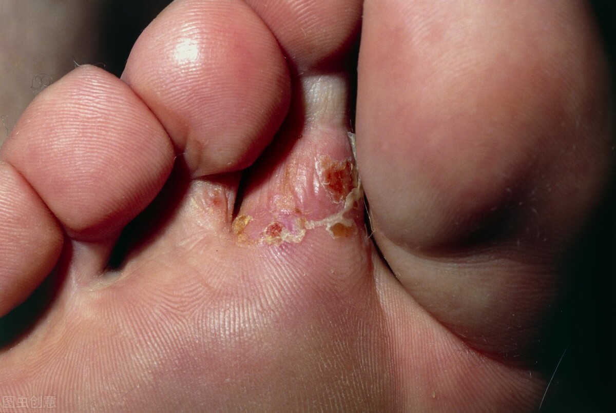 脚气怎么治专家现场演示,如何治脚气和脚汗