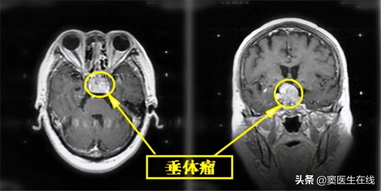 怀孕了可以吃甲磺酸溴隐亭吗,孕期吃甲黄溴隐亭有什么好处