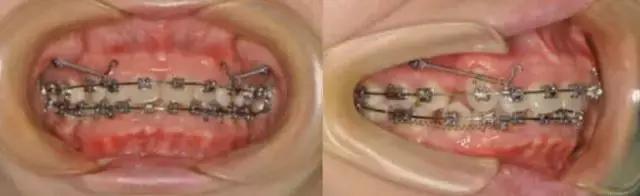 龅牙牙齿矫正的最佳方法,龅牙凸嘴露龈笑