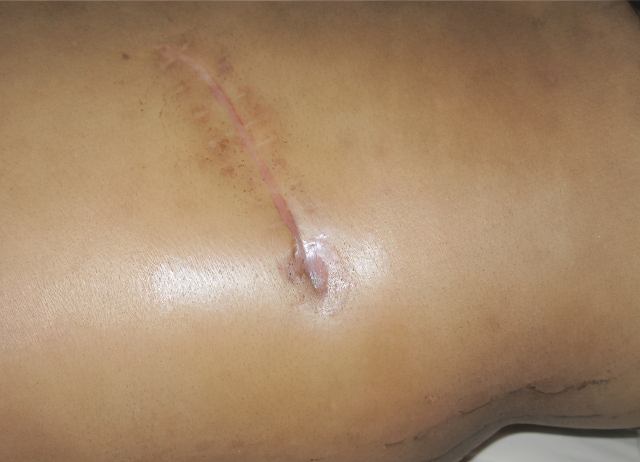 腰椎结核用哪种药比较好,腰椎结核的患者要关注什么