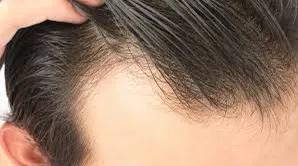 米诺地尔治疗脱发成功案例 (米诺地尔治疗脱发的正确使用方法)