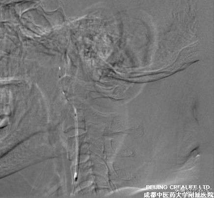 颈动脉狭窄介入治疗,颈动脉狭窄介入手术多少钱