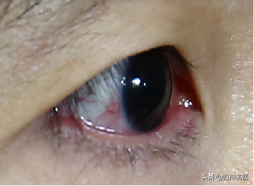 一把年纪了脸上还爆痘,一把年纪了脸上还起痘