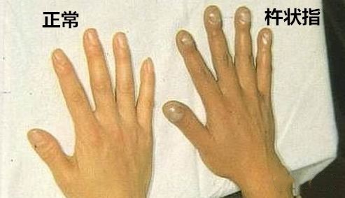手部出现3种异样可能患癌,手出现问题是什么病前兆