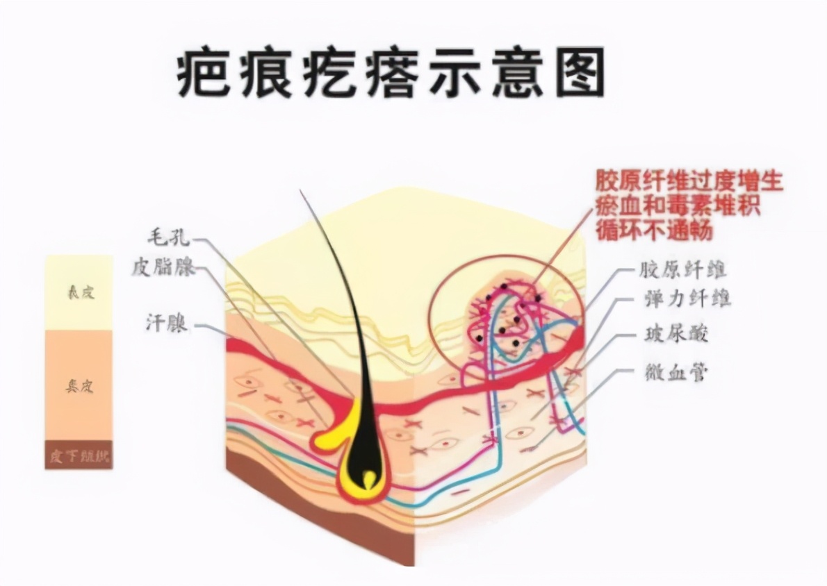 打软化针关注事项,瘢痕疙瘩软化针