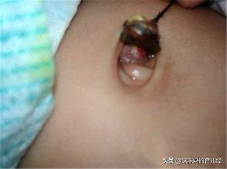 新生儿脐带没有消毒怎么办,脐带绕颈两周怎么办要关注什么
