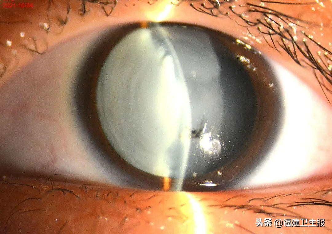 儿童眼睛被铅笔戳伤在瞳孔中间,小孩打闹眼睛被戳伤流了一点血