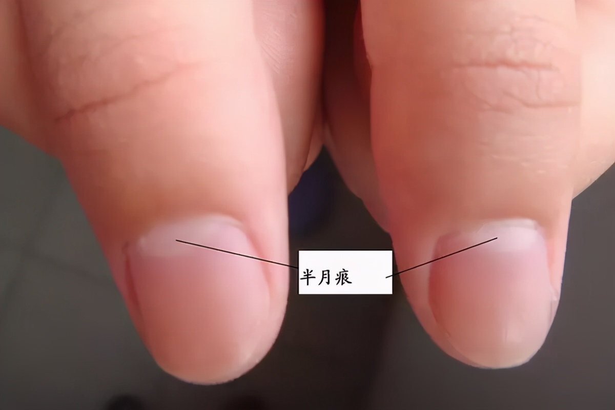 为什么有人指甲上没有月牙,为什么有的人指甲周围没有死皮
