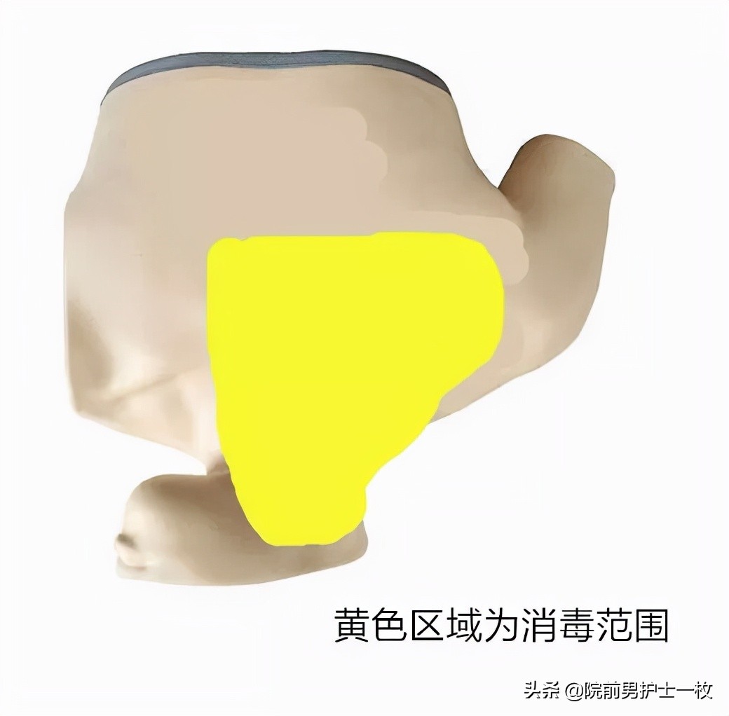 深静脉置管锁骨下静脉穿刺部位,深静脉穿刺置管拔出需要关注什么