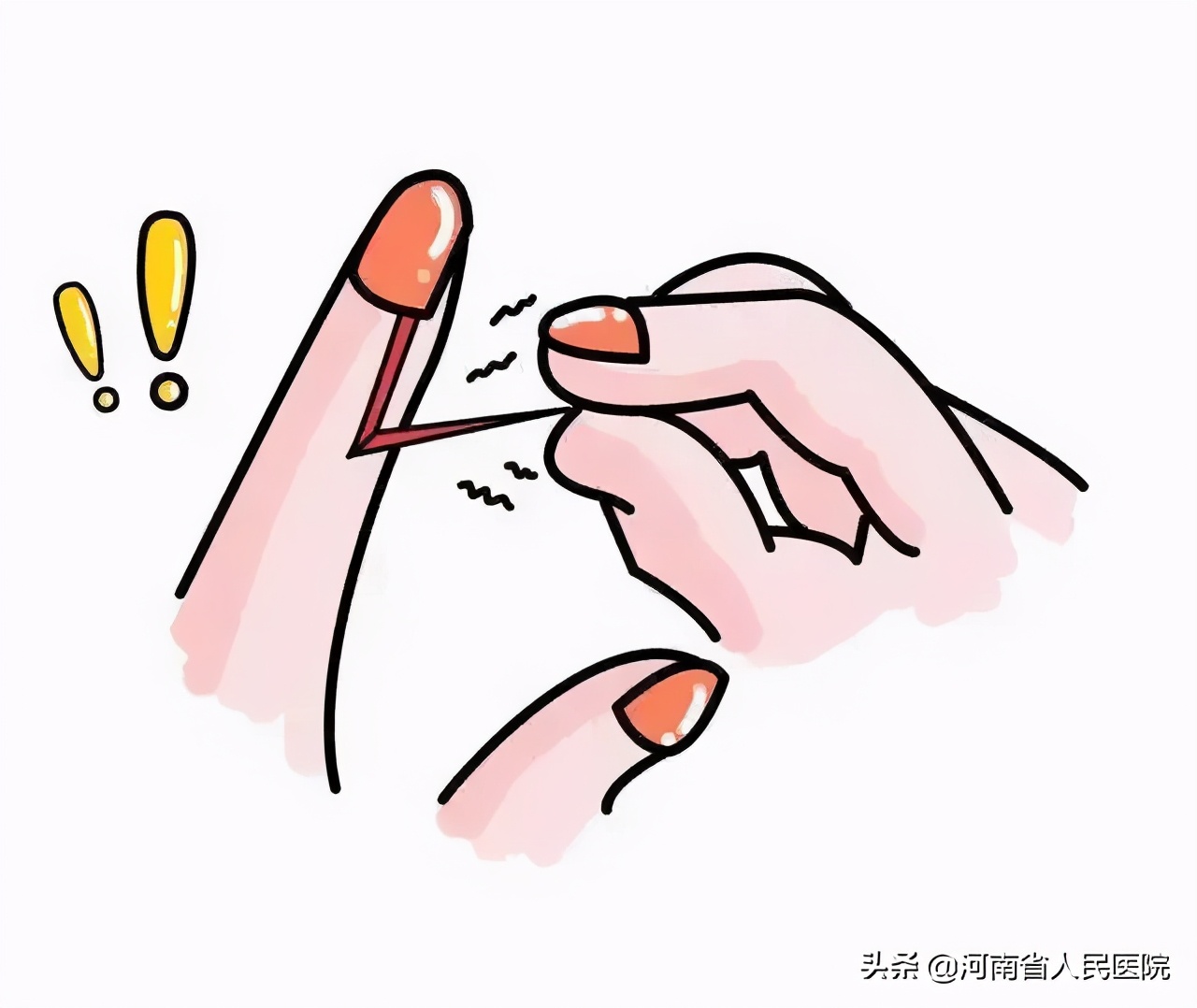 外伤引起指甲裂开钻心疼怎么止疼,指甲一直往肉里长很痛怎么办