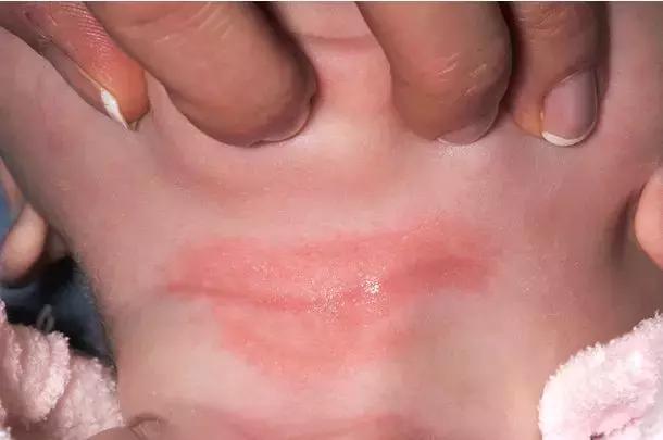 婴儿脖子皮肤比较黄是啥原因,婴儿脖子上起鸡皮是怎么回事