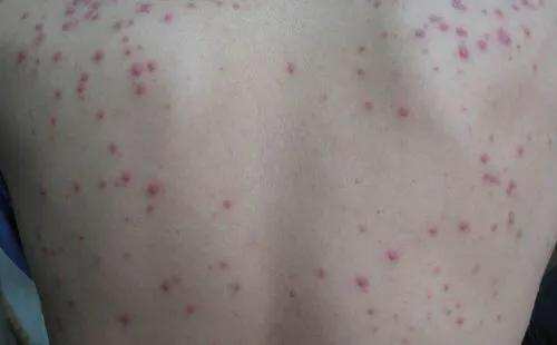 乙肝患者皮肤发黄还意味着什么,乙肝患者皮肤出现红点