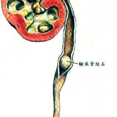 输尿管结石快要掉下来的前兆疼痛,得了结石不治疗会怎样