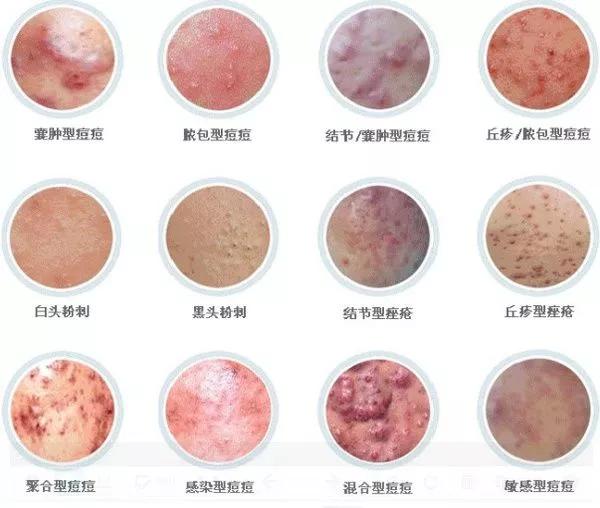 疮肿的治疗方法,疮的症状和护理办法