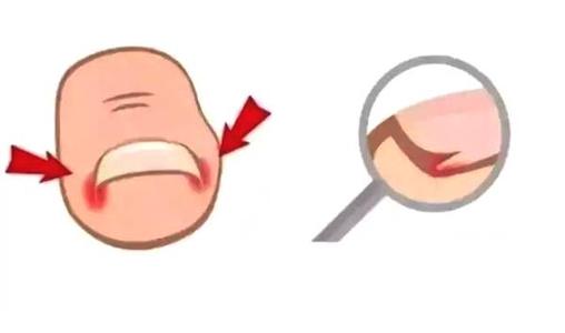 甲沟炎症状怎么治,甲沟炎是怎么引起的治疗方法