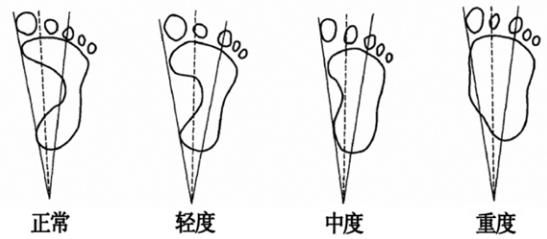 扁平足穿鞋子容易变形怎么改善,扁平足对日常有什么影响