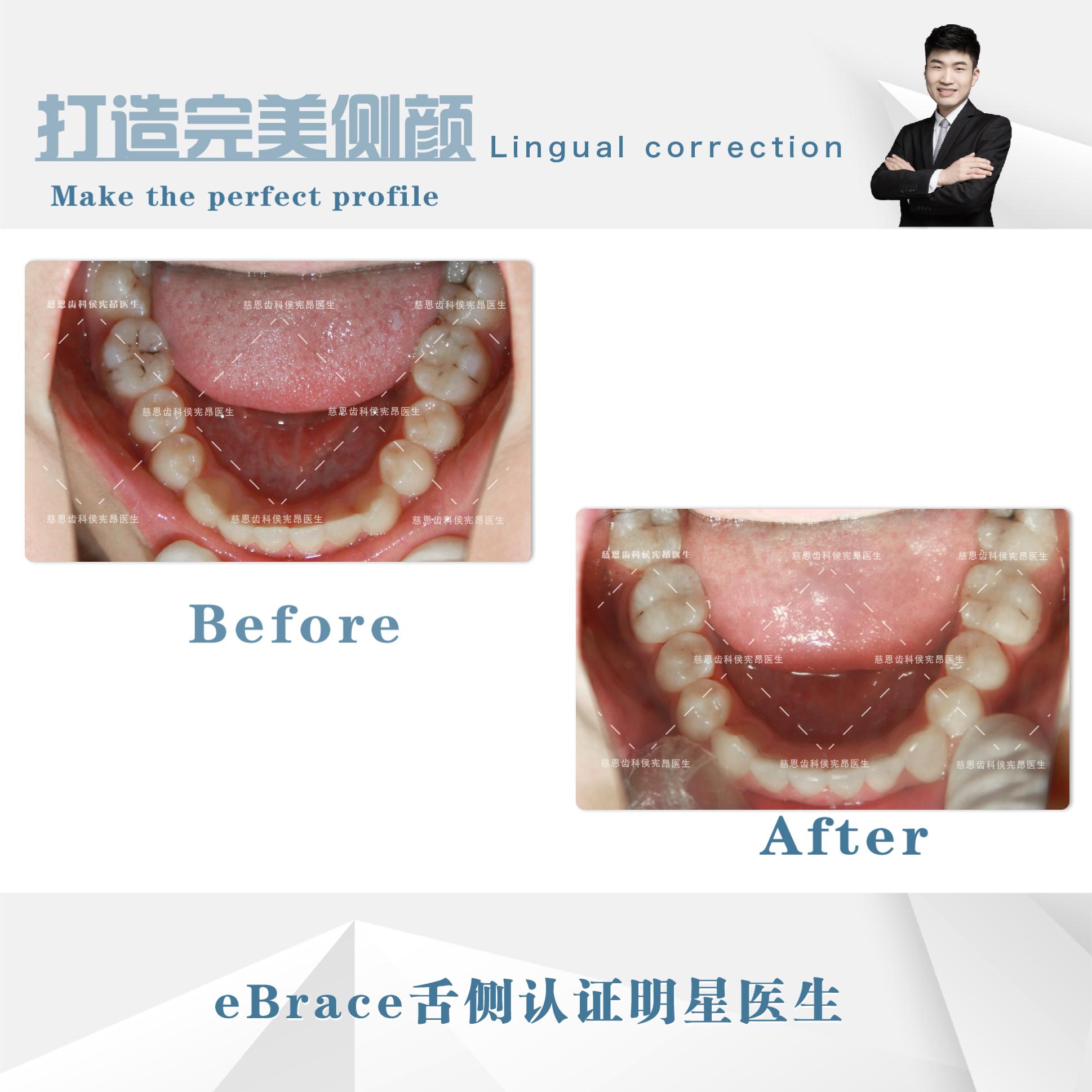 牙齿地包天矫正前后脸型对比,牙齿地包天矫正最低价多少钱