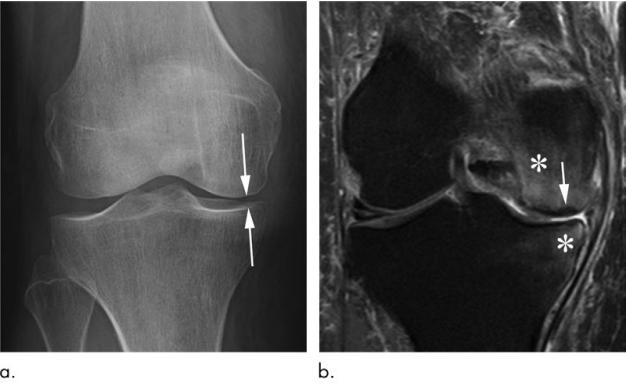 膝关节骨关节炎注射什么药好,膝关节炎注射激素有什么副作用