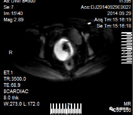 宫颈癌mri诊断,宫颈癌的mr扫描技术