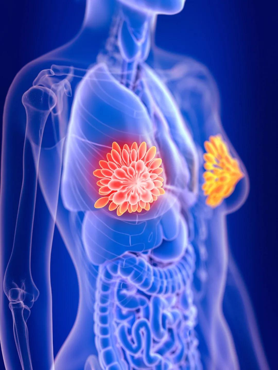 乳腺癌转移风险预测,乳腺癌复发风险评估基因检测评分