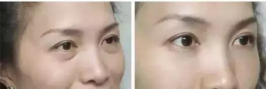 去眼袋15年后有细纹怎么办,祛眼袋之后会不会看着很平