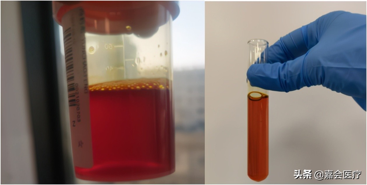 尿液突然变红、变绿？关注这些常见药会改变尿液颜色