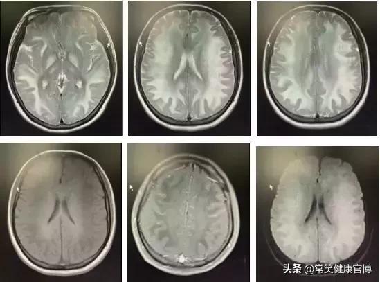 油漆中毒会不会伤脑,油漆中毒对大脑有什么损伤