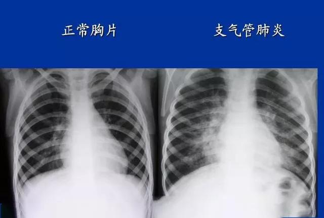 慢性气管炎最常见并发症,急性气管支气管炎主要表现症状