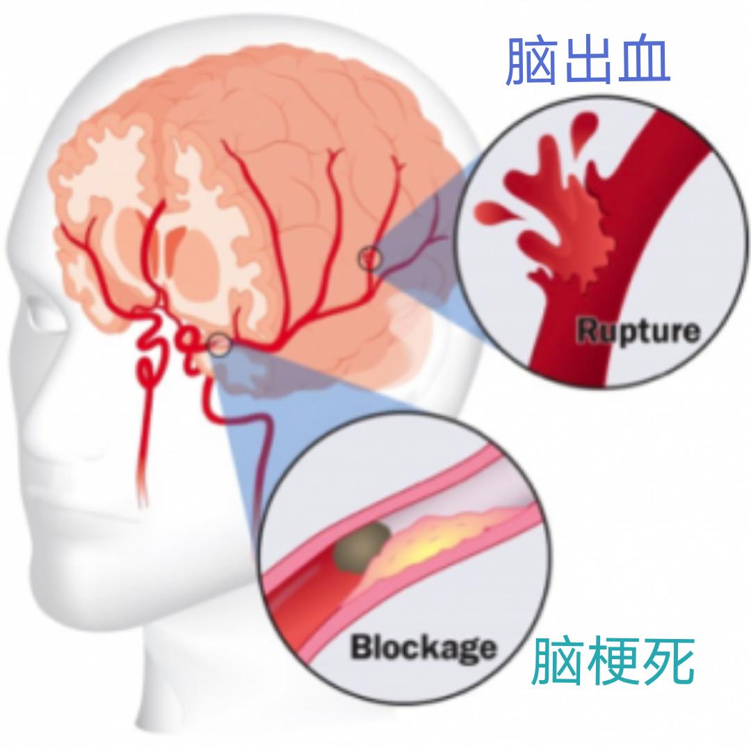 高血压大脑有什么影响,更年期高血压的症状和表现