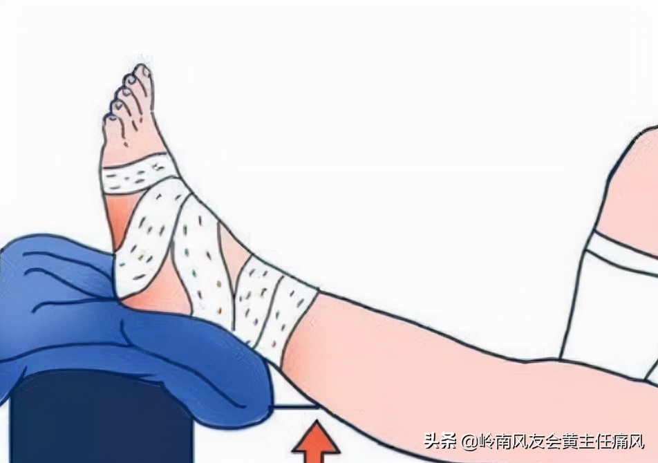 痛风夜间发作的原因及缓解方法,痛风拿冰敷能缓解疼痛感吗