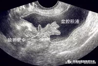 小腹坠胀感觉有东西要掉出来,小腹坠胀流了一点血