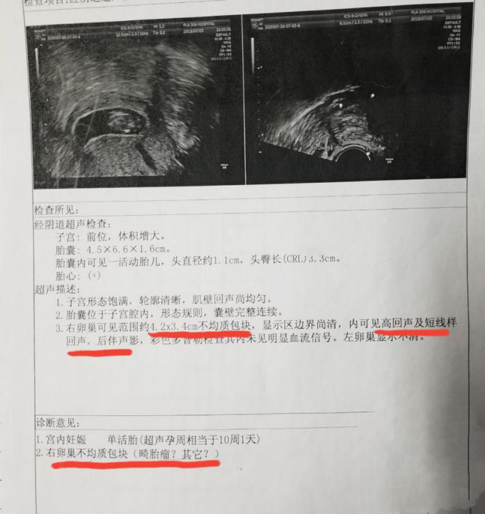 孕晚期突发腹痛：当心卵巢肿瘤扭转