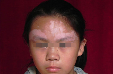 孩子脸上有斑是肚子有虫吗,宝宝脸上长白斑是肚子有虫子吗