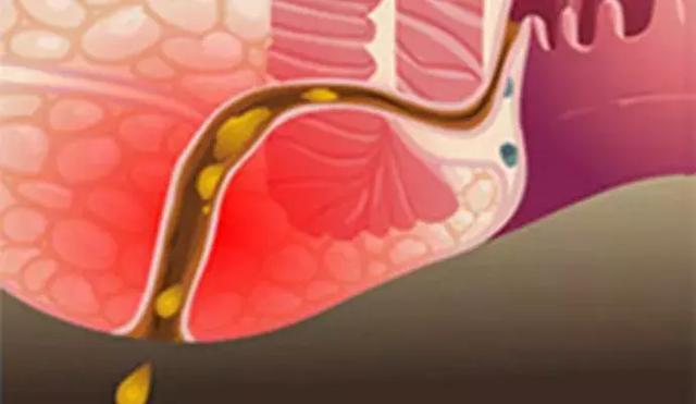 肛瘘应该怎么办不做手术可以吗,肛瘘长到睾丸附近不做手术行吗